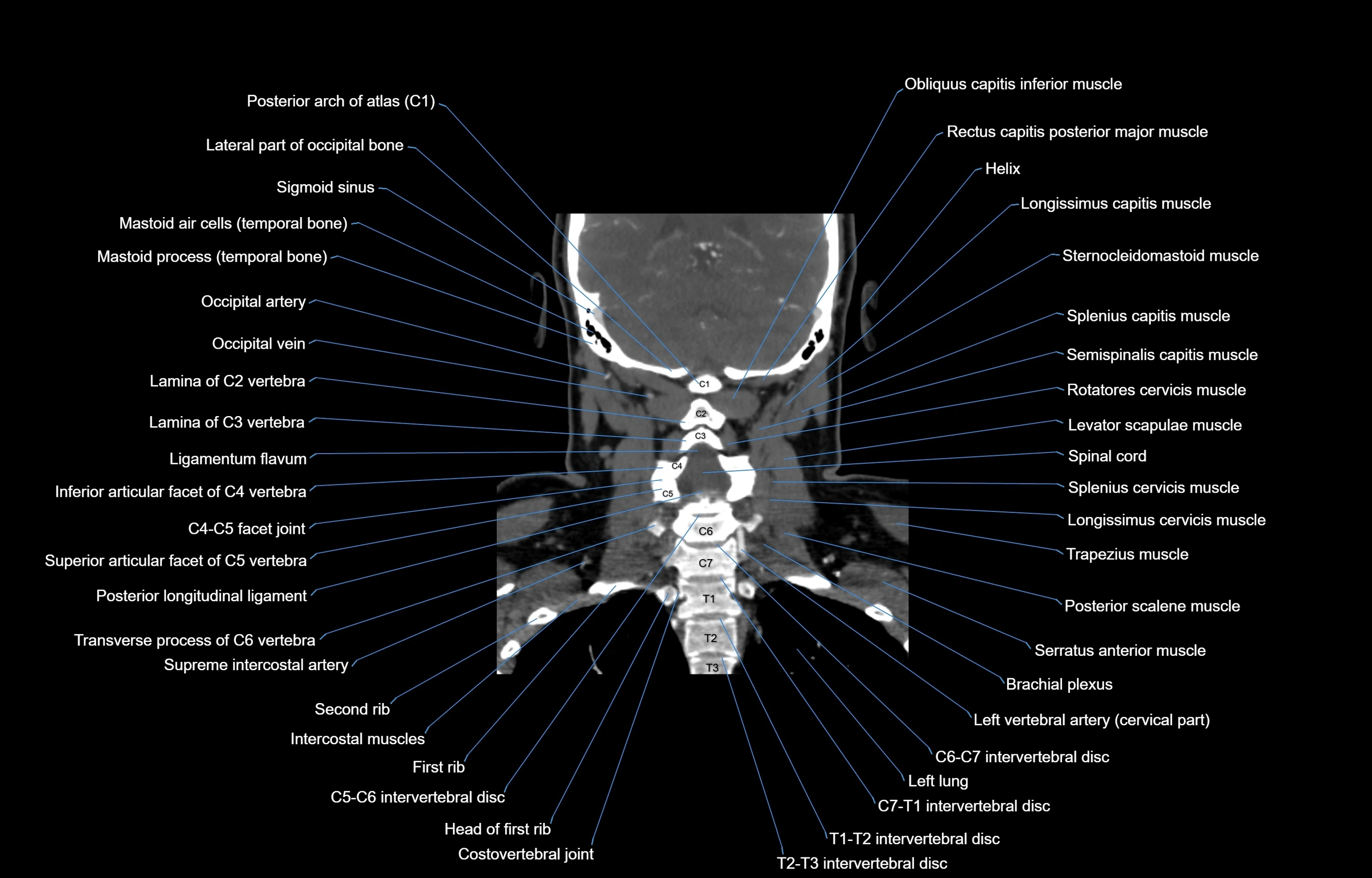 CT Neck coronal  cross sectional anatomy labelled 3D  radiology  image-00047.webp